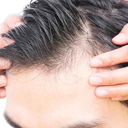 male-pattern-baldness-treatment